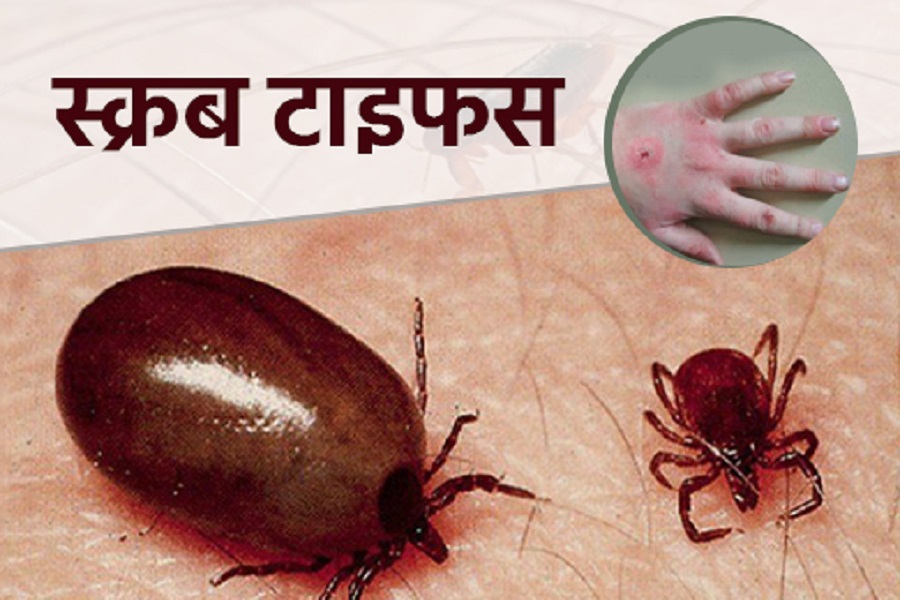 बागलुङमा भेटिए स्क्रब टाइफसका बिरामी !